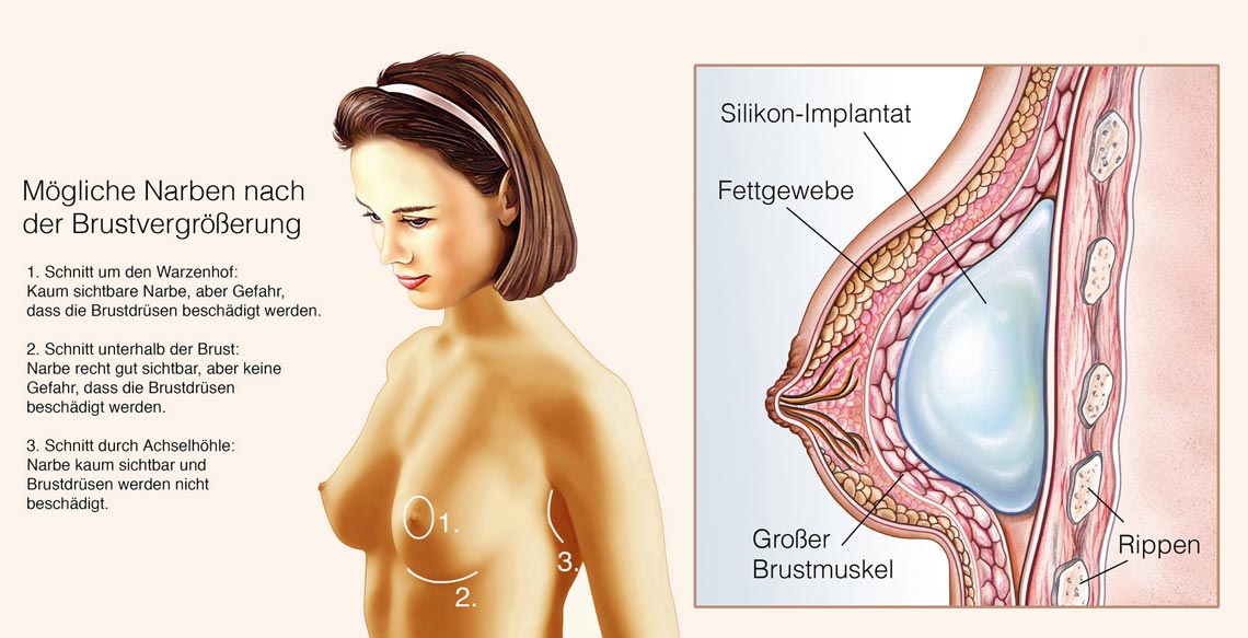 Mögliche Narben nach einer Brustvergrößerung