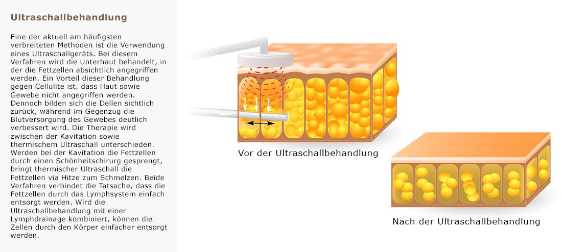 Cellulitebehandlung Ultraschallbehandlung - Infografik