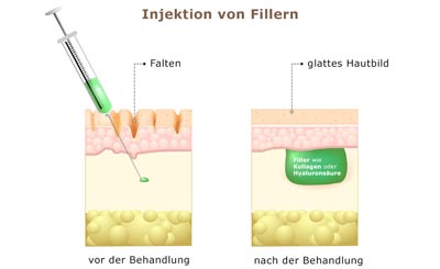 Injektion von Fillern - Schaubild